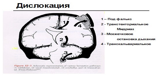 Виды вклинения мозга