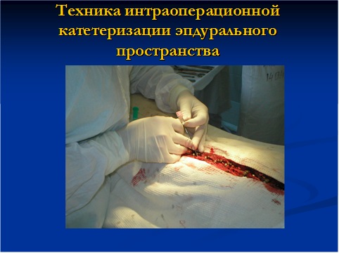 Техника интраоперационной катетеризации эпидурального пространства