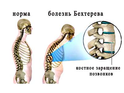 болезнь бехтерева