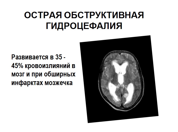 Острая обструктивная гидроцефалия