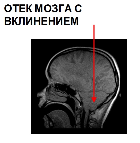 Отек мозга с вклинением