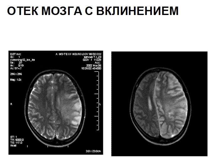 Отек мозга с вклинением