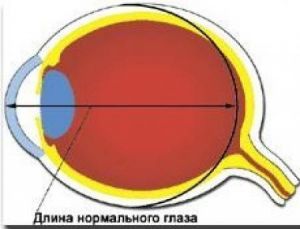 Близорукость (миопия)